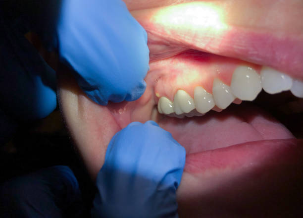 Best Emergency Wisdom Teeth Removal in Belding, MI